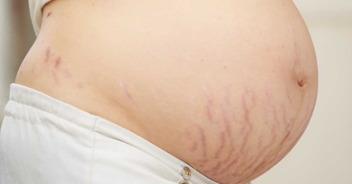 Aprenda a cuidar bem da pele e evitar estrias na gravidez