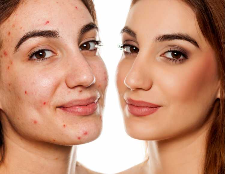 maquiagem para disfarçar manchas de acne