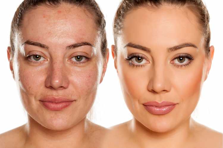 maquiagem para disfarçar manchas no rosto antes e depois